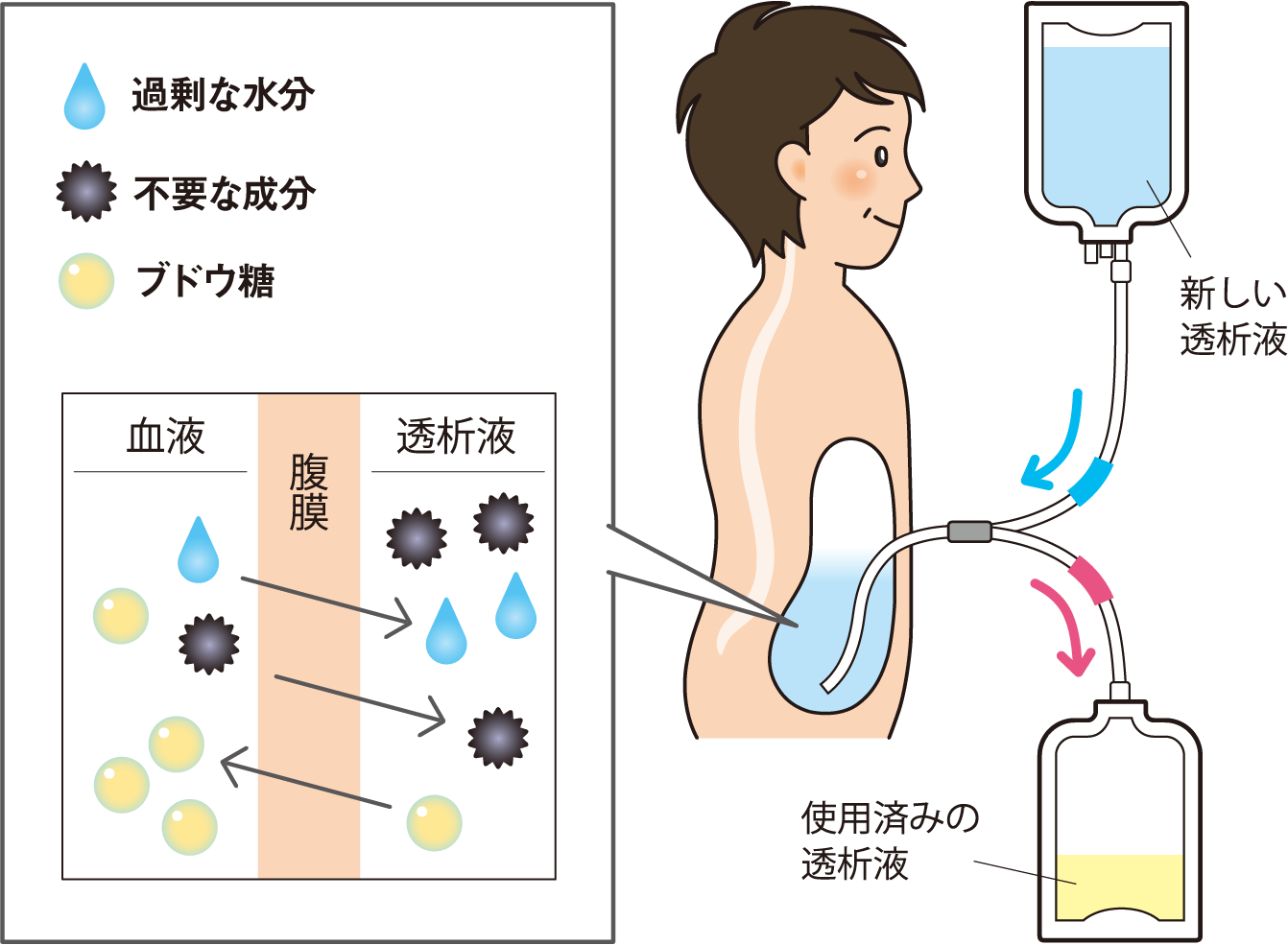 腹膜透析の基礎知識 | おうちで透析